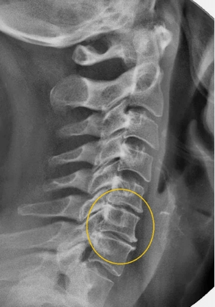 Osteohondroza vratne hrbtenice na rentgeni